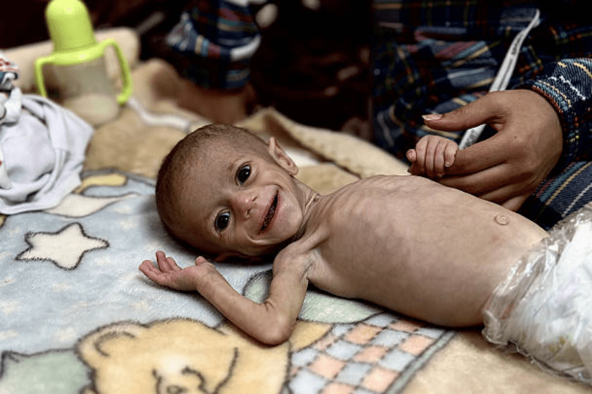 Malnourished Gaza baby Siwar