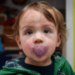 Canada measles outbreak 2025