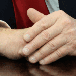 Trump leg swelling bruises