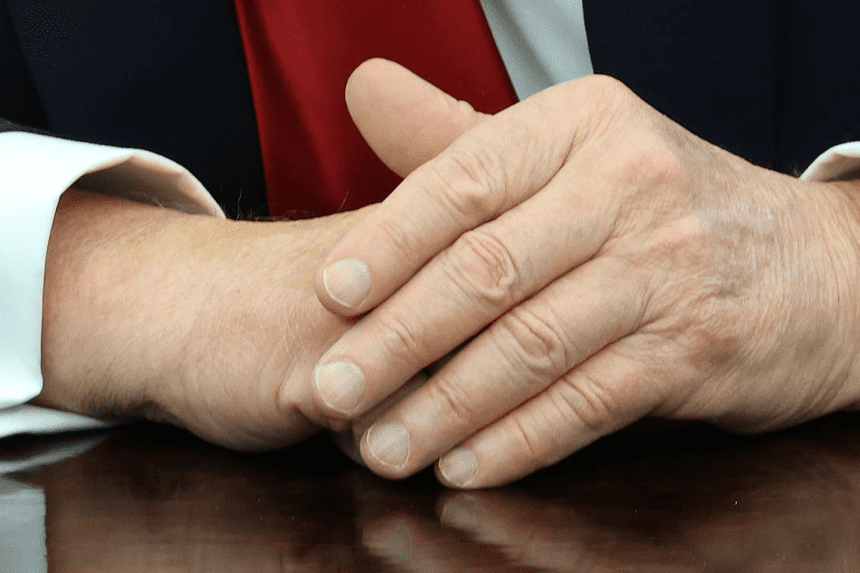 Trump leg swelling bruises